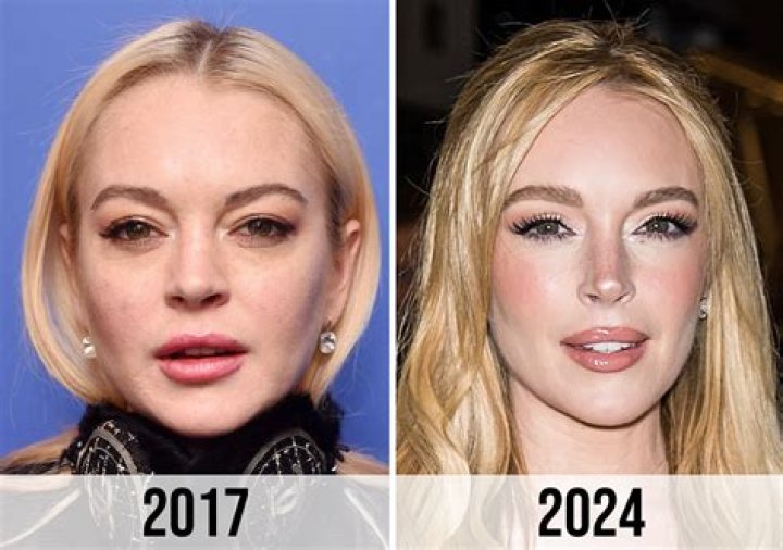 Unveiling The Truth Behind Lindsay Lohan's Plastic Surgery Journey